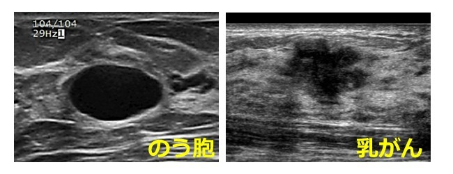 乳がん検診での嚢胞(のうほう)